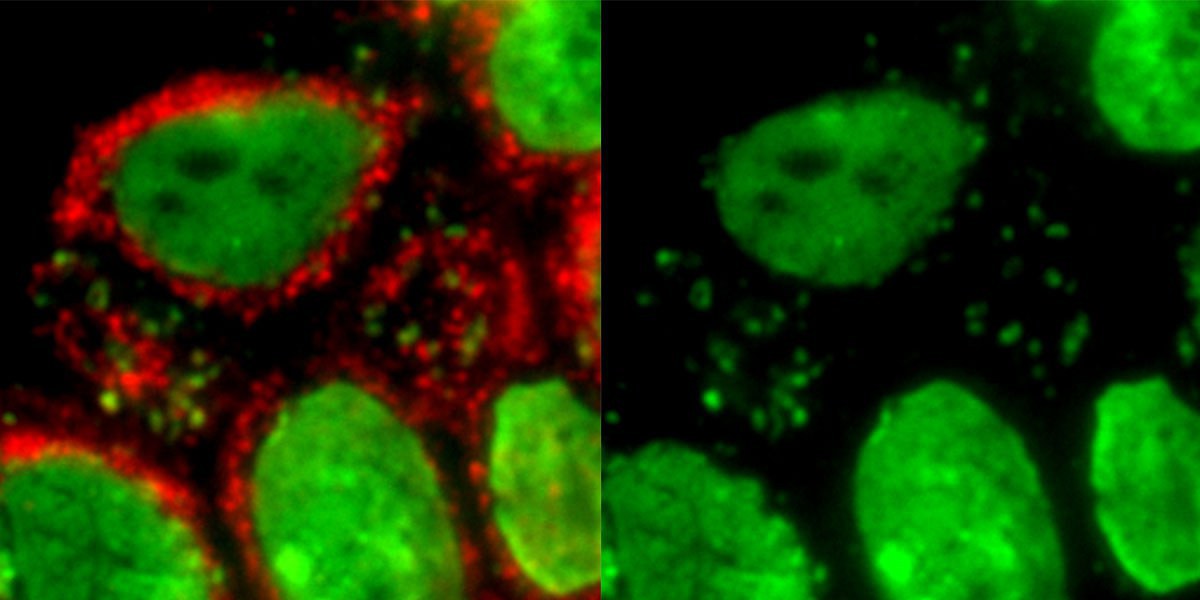 In das Zytoplasma ausgetretene DNA (grün) - kolokalisiert mit dem DNA-Sensor cGAS (rot) in der Haut von Patienten mit myotoner Dystrophie Typ 2.