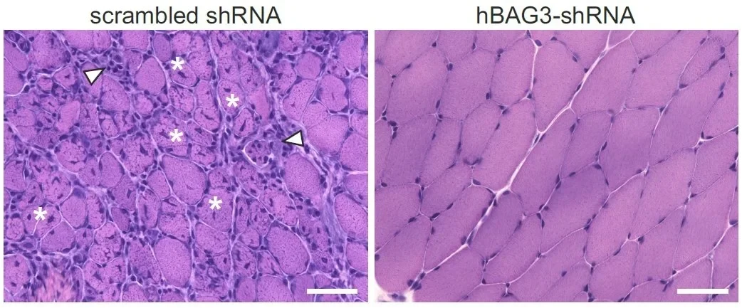 Hämatoxylin-Eosin-Färbung von histologischen Schnitten von Skelettmuskelbiopsien. - Nach einer experimentellen Therapie, die die Menge des krankmachenden BAG3-Proteins vermindert, zeigen sich deutlich weniger Schäden (Sternchen) und Entzündungszellen (weiße Dreiecke) in der Skelettmuskulatur der behandelten Mäuse (rechts, hBAG3 shRNA) im Vergleich zu den Kontrollen (links, scrambled shRNA).
