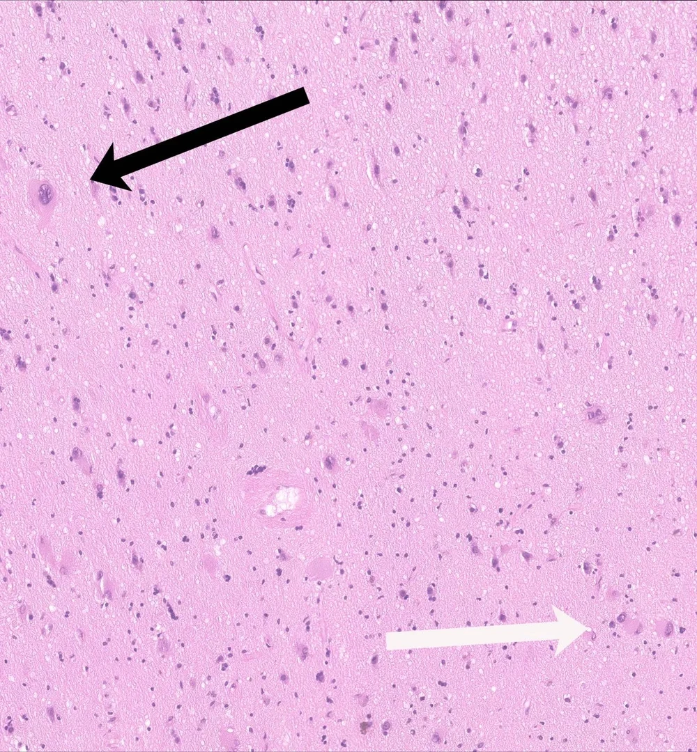 Biopsiepräparat eines Epilepsie-chirurgischen Eingriffs - Es zeigt eine fokale Dysplasie, die aus erheblich vergrößerten, fehlgestalteten Nervenzellen (schwarzer Pfeil) sowie sogenannten Ballonzellen, bei denen der Zellkern nicht im Zentrum liegt (weißer Pfeil), besteht