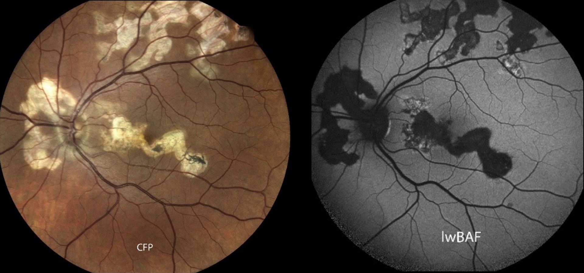 Das Bild zeigt ein von der seltenen serpiginösen Chorioretinopathie betroffenes Auge. - Der Name kommt von der „schlangenartigen“ Ausbreitung der Krankheit über den Augenhintergrund. In der Augenhintergrund-Fotografie (links) zeigen sich Narbenareale in einem hellen Gelbton. Aktive entzündliche Läsionen zeigen sich in der Fundusautofluoreszenz (rechts) meist als helle Bereiche.