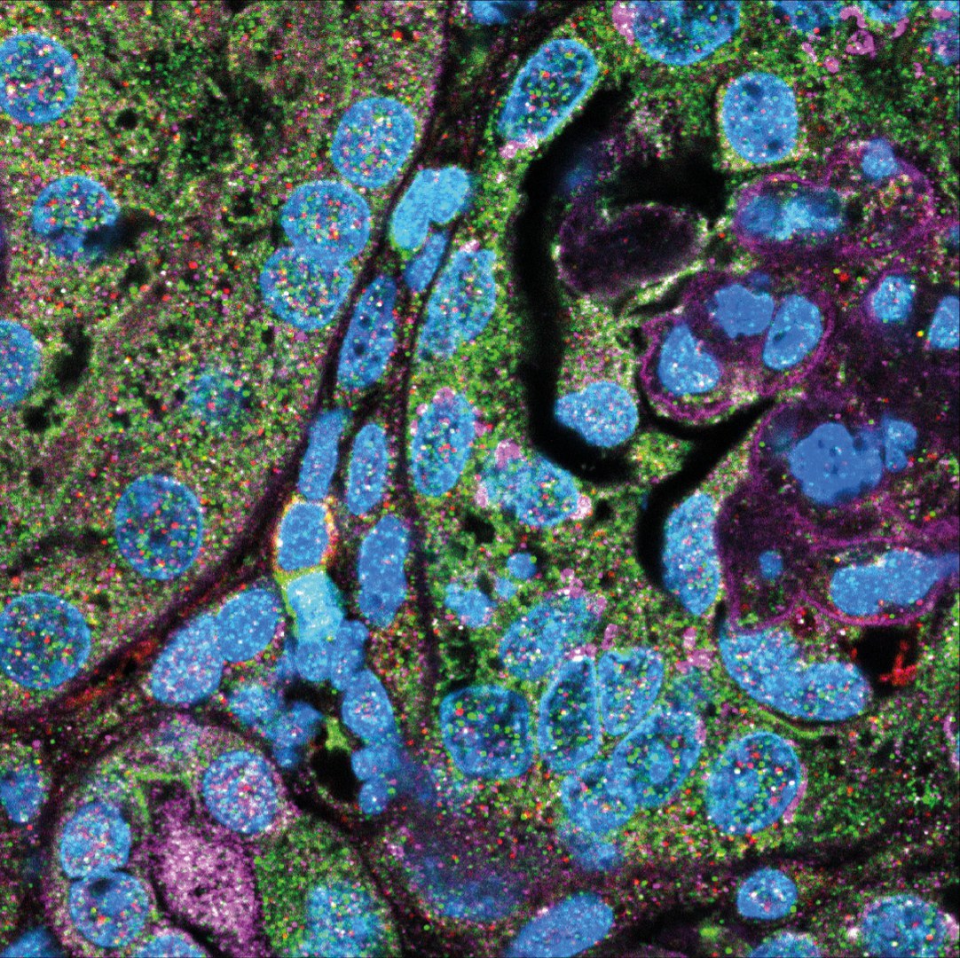 Immunofluoreszenzfärbung - von MAIT-Zellen (grün) neben mononukleären Phagozyten (rot) in Nierenschnitten von Mäusen mit experimenteller Glomerulonephritis. Zellkerne in blau.