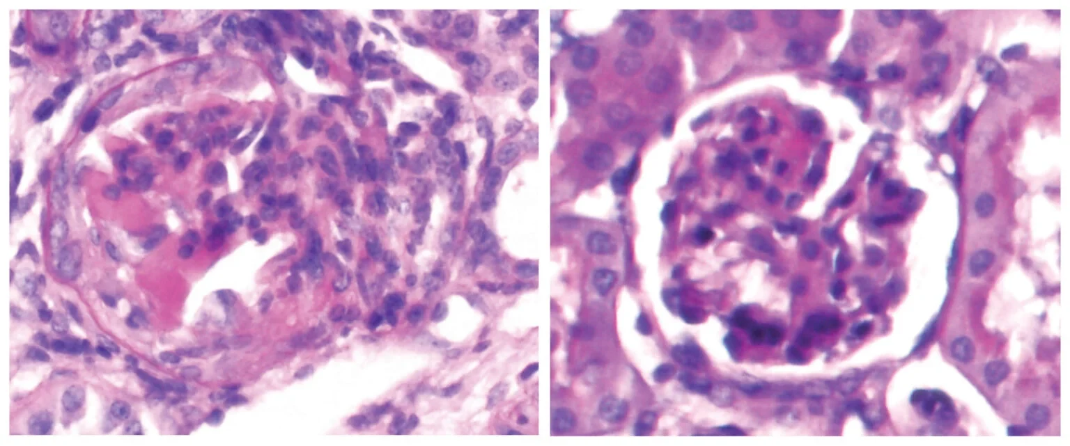 Histologische Aufnahmen zeigen den geschädigten Glomerulus (links) bei cGN-Mäusen sowie den weniger geschädigten Glomerulus (rechts) nach Behandlung mit einer niedrigen Dosis Glukokortikoiden.