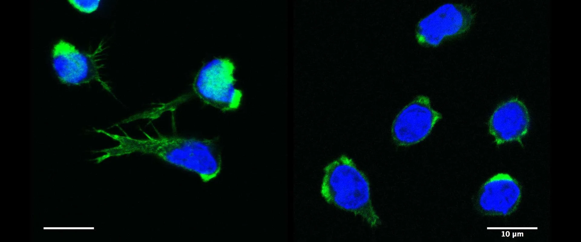 T-Zellen (blau: Zellkerne; grün: filamentöse Aktinstrukturen) eines gesunden Spenders (links) und eines Patienten mit DOCK11-Mangel (Dedicator of Cytokinesis 11) (rechts), die eine deutliche Verringerung der Filopodienbildung aufweisen.