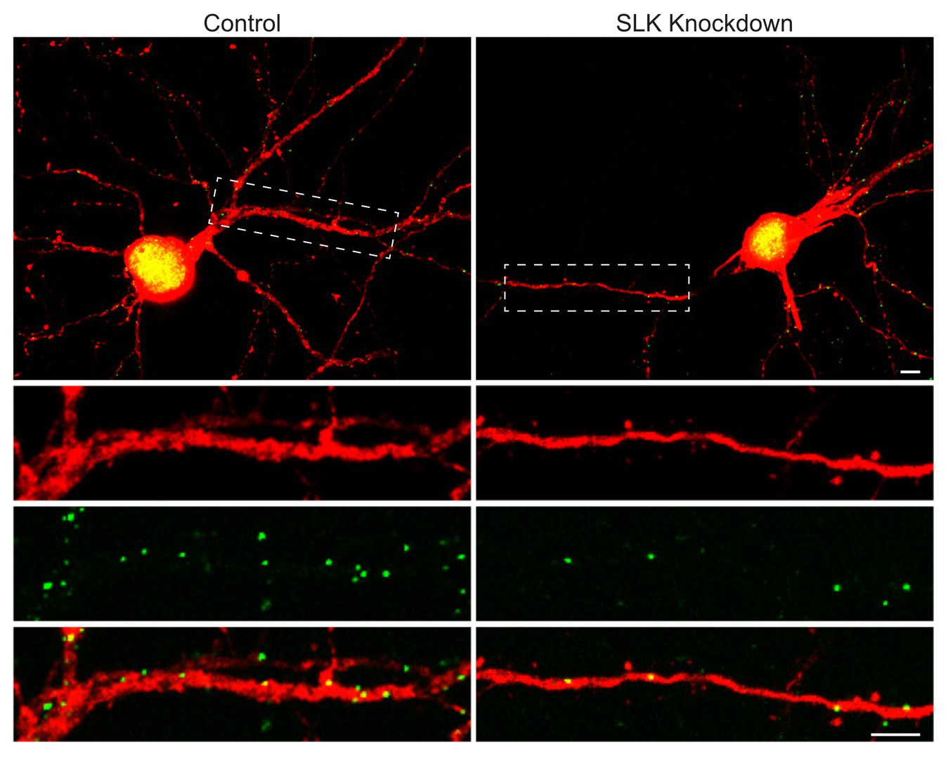 In der Nervenzelle - rechts fehlt das SLK-Molekül. Dadurch verliert sie einen Teil ihrer inhibitorischen Postsynapsen (grün) - das sind die „Regler“, die die Antwort der Zelle auf einen Reiz reduzieren.