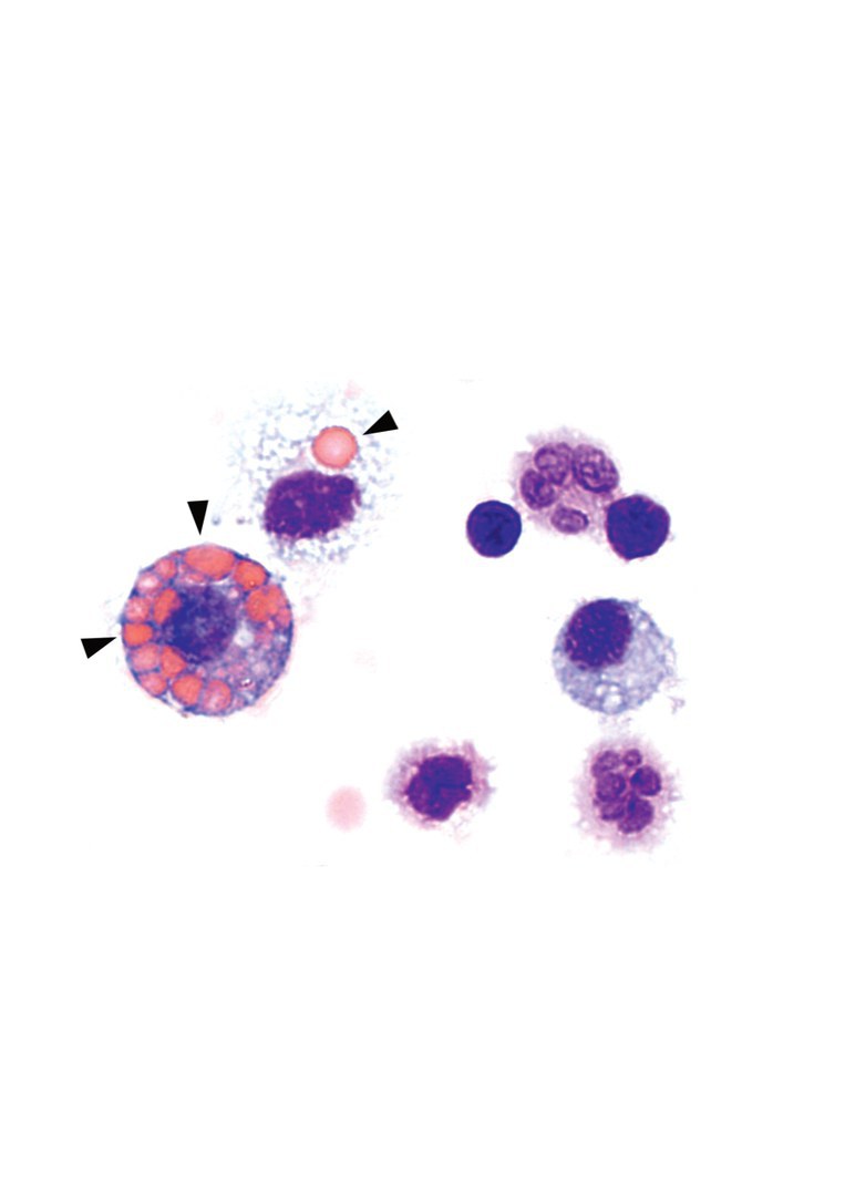 Immune cells isolated from the lungs of mice with ANCA-associated vasculitis: - macrophages (purple big cells on the left side) in the alveoli contribute to the elimination of bleeding by eating up the red blood cells (reddish very small cells, arrows).