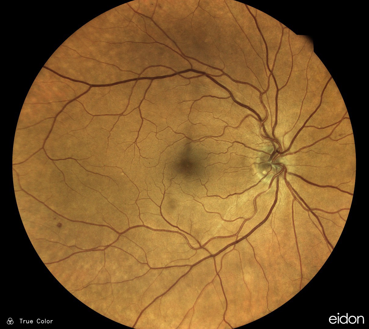 The fundus of the human eye is well perfused. - When the vessels are photographed through the lens of the eye, neuronal networks can detect certain diseases on the basis of the images.