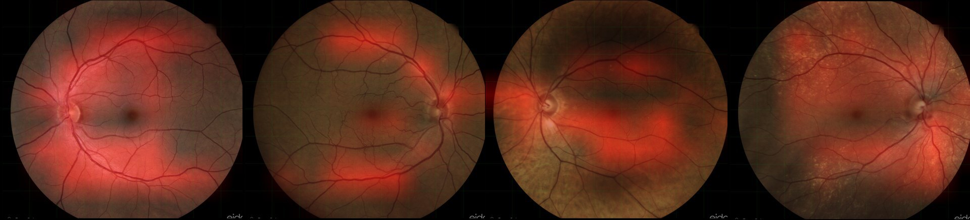 The algorithm pays particular attention - to the large retinal vessels when detecting peripheral arterial disease. This is shown by the bright red areas in the image, which were particularly important for the classification.