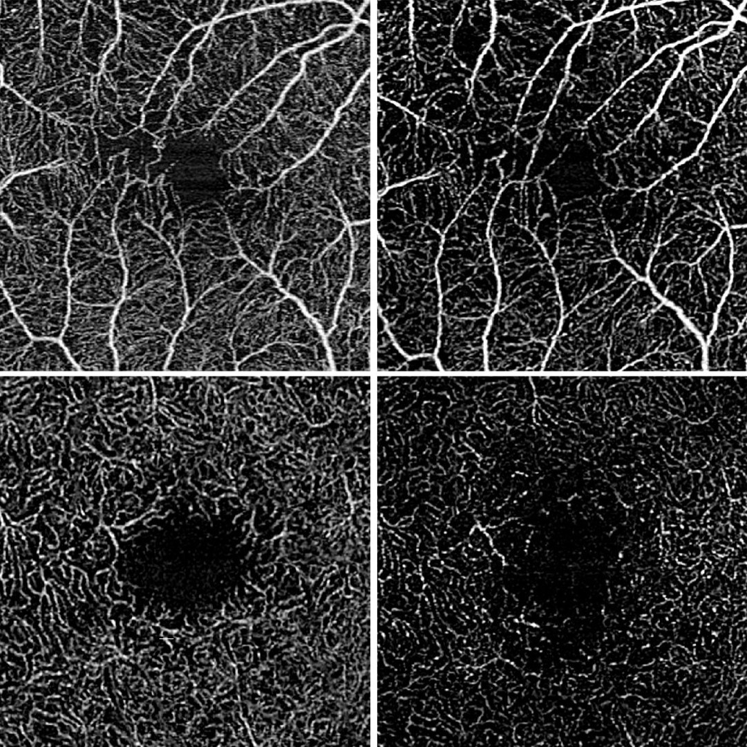 Optical coherence tomography angiography showing ocular vascular perfusion in intermediate uveitis: - The upper images show the superficial and the lower images the deep retinal blood flow. The initial state is shown on the left and the state after disease worsening is shown on the right. The blood flow density has decreased in both the superficial and deep retinal layers.