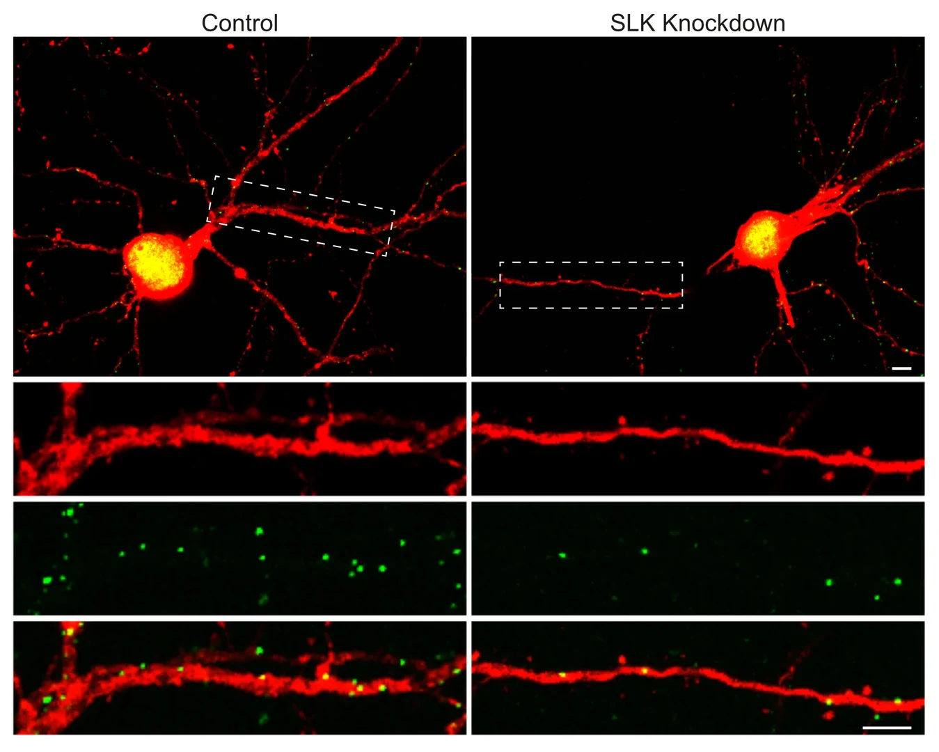 The nerve cell - on the right lacks the SLK molecule. As a result, it loses some of its inhibitory postsynapses (green) - these are the "regulators" that reduce the cell's response to a stimulus.