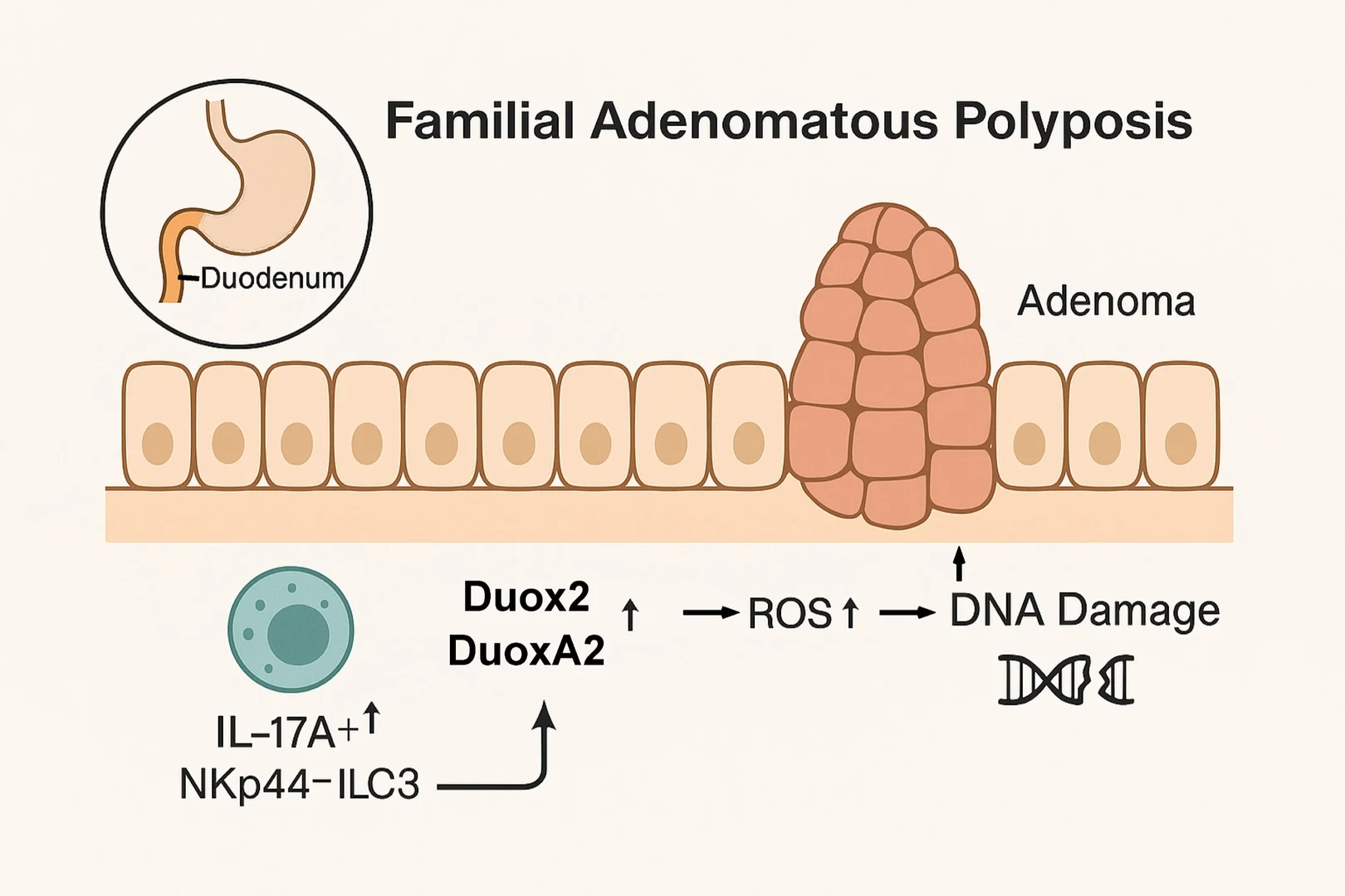 Process in the local immune system - that can drive the development of cancer in hereditary FAP syndrome. Image was generated with ChatGPT4o. 